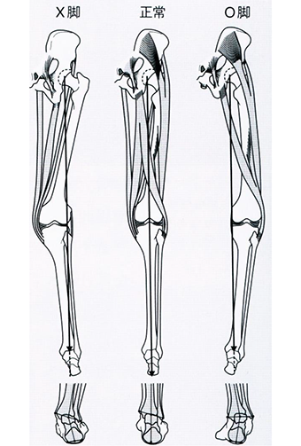 X脚−外反足　直膝−直足　O脚−内反足