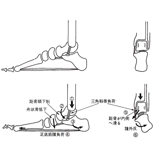 踵（かかと）のバランスは体重をかけた時に、容易に崩れてします部位でもあります。